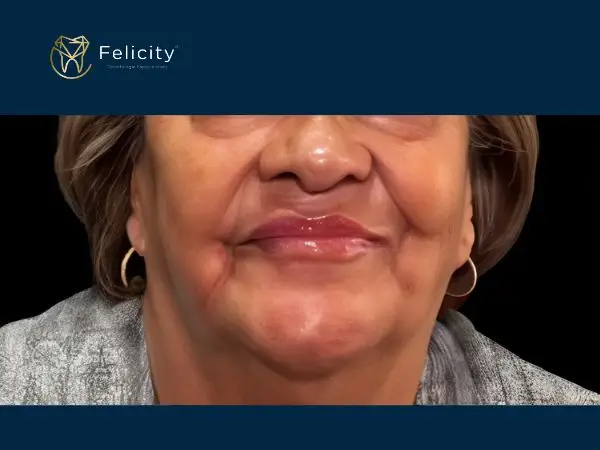 A diferença que a protese bem colocada faz em sua aparencia - Felicity boituva - Depois
