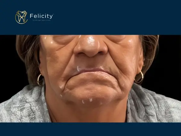 A diferença que a protese bem colocada faz em sua aparencia - Felicity boituva