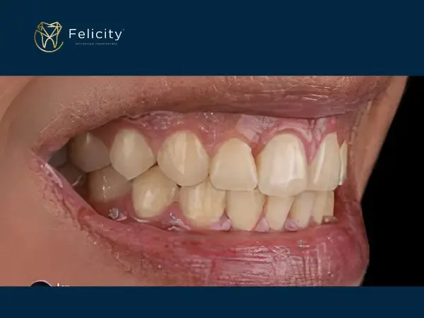 Clareamento em Boituva é na Felicity - Antes