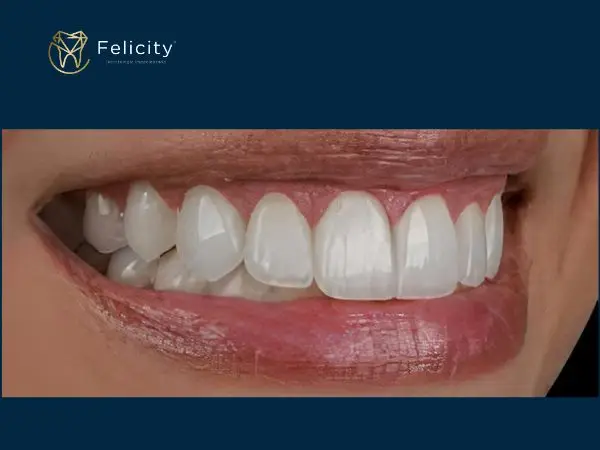 Clareamento em Boituva é na Felicity - Depois