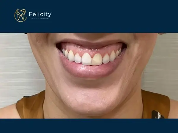 Estética em Boituva é na Felicity - Antes