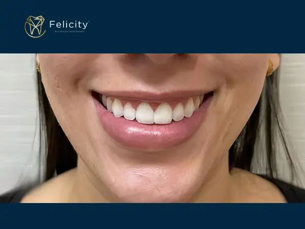 Estética em Boituva é na Felicity - Depois