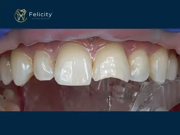 Estética em Boituva é na Felicity Faceta- Antes