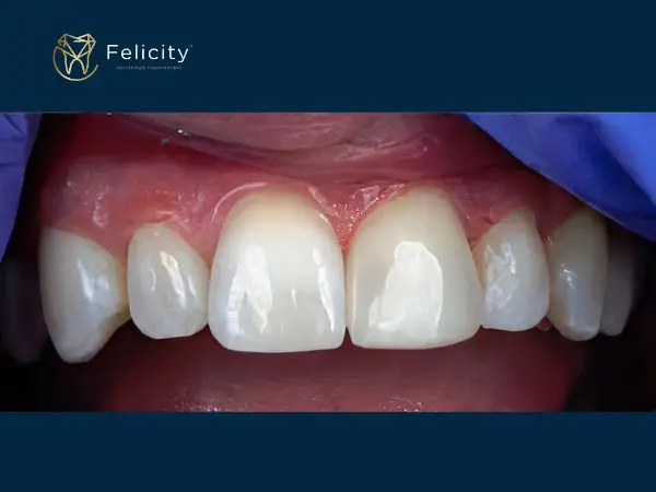 Estética em Boituva é na Felicity Faceta - Depois