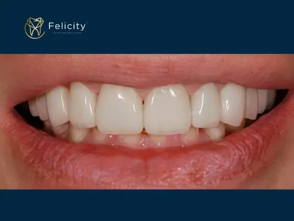 Lentes de resinas reconstrução total é na Felicity - Depois