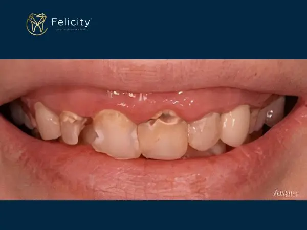 Lentes de resinas reconstrução total e na Felicity em Boituva - Antes