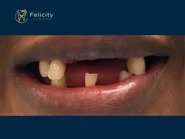 Prótese Parcial é na Felicity em Boituva - Antes