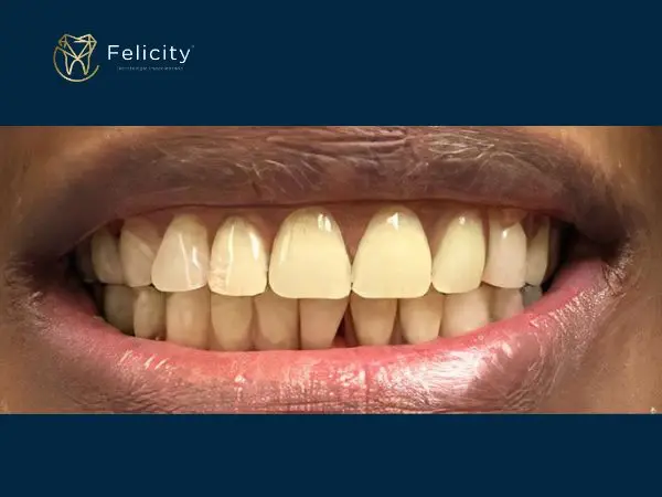 Prótese Parcial é na Felicity em Boituva - Depois