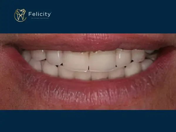 Prótese Removivel em Boituva é na Felicity - Depois