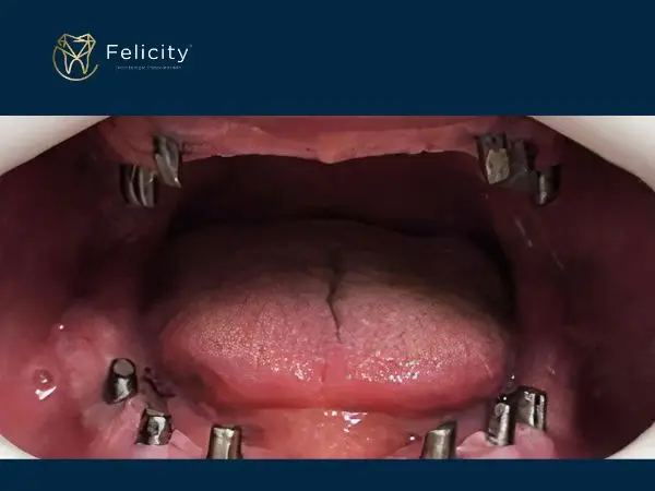 Prótese Sobre Implante em Boituva é na Felicity - Antes