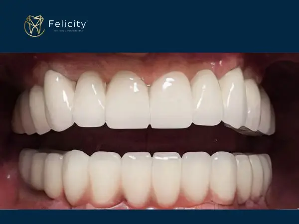Prótese Sobre Implante em Boituva é na Felicity - Depois