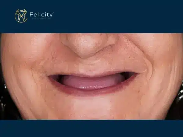 Prótese Total em Boituva é na Felicity - Antes