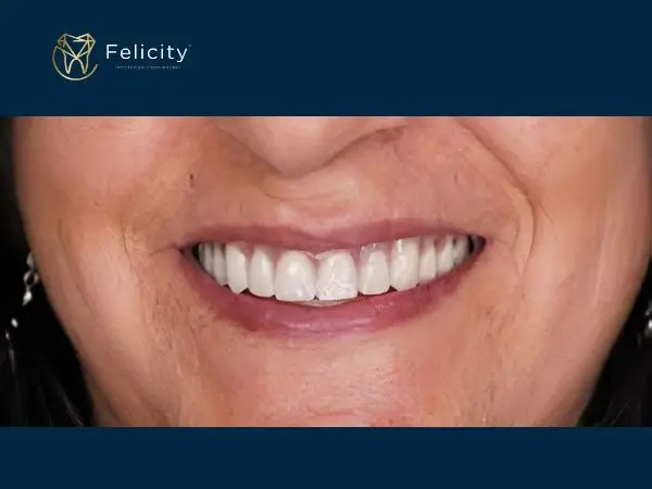 Prótese Total em Boituva é na Felicity - Depois