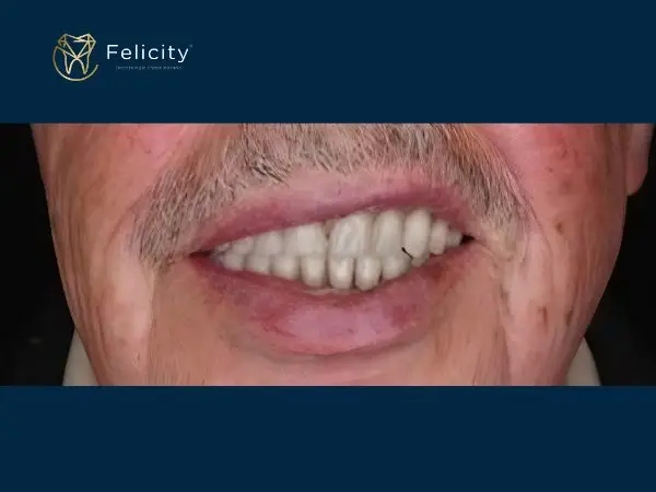 Prótese em Boituva na Felicity Depois