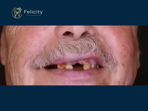 Prótese em Boituva na Felicity