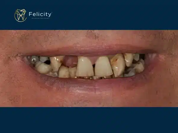 Prótese removivel em boituva e na Felicity - Antes