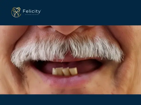 Protesse paracial e removivel em boituva é na felicity