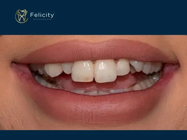 Remodelação do sorriso em Boituva é na Felicity - Antes