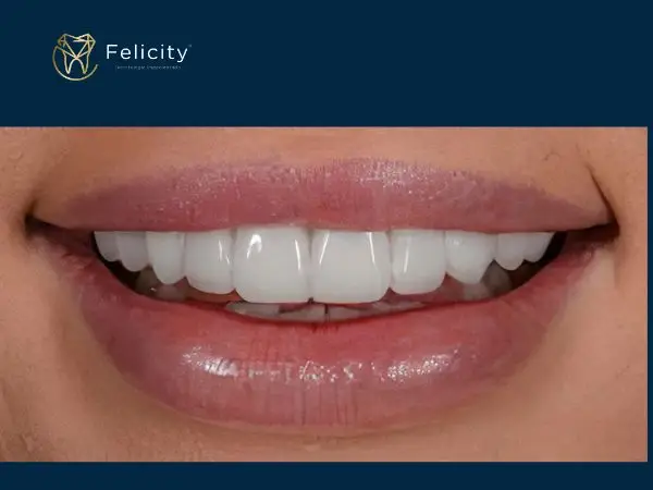 Remodelação do sorriso em Boituva é na Felicity - Depois