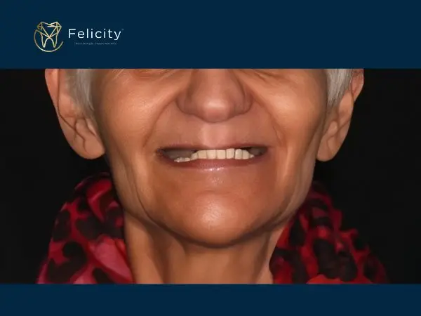 Sorrir com protese em Boituva é na Felicity - Antes