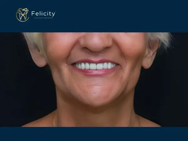 Sorrir com protese em Boituva é na Felicity - Depois