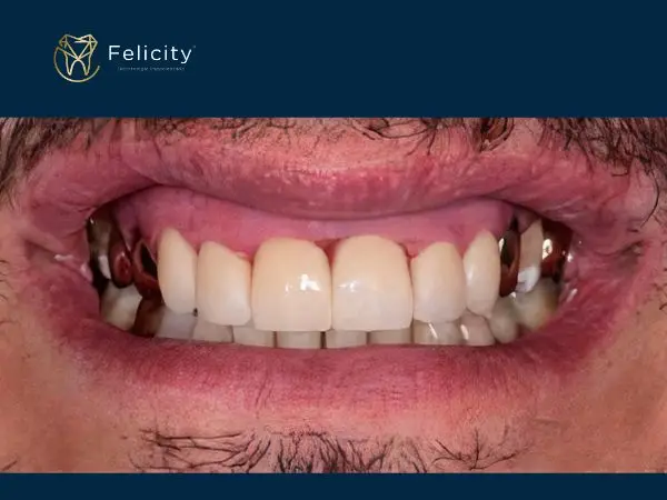 Sorrisos Renovados é em Boituva Depois